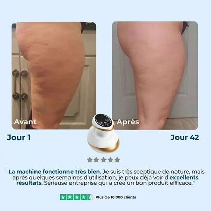 SmoothTone™ – Dispositif de Massage Raffermissant