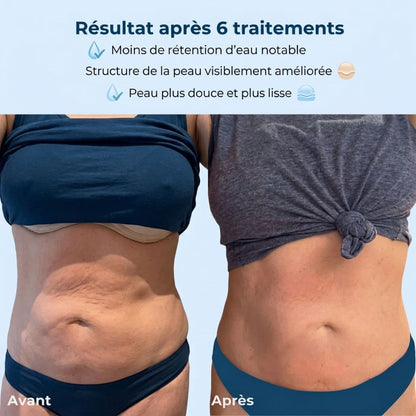 SmoothTone™ – Dispositif de Massage Raffermissant