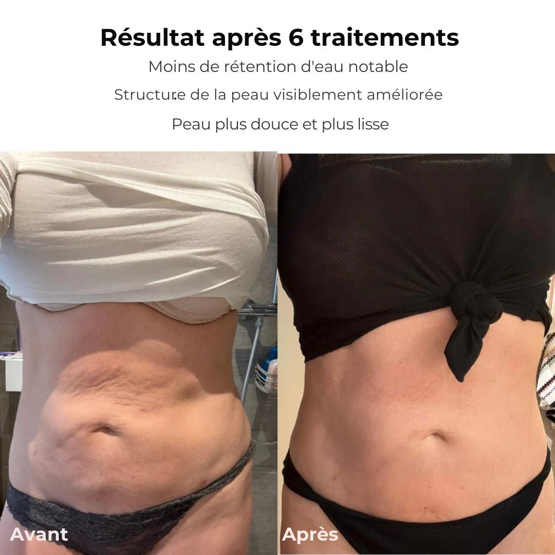 SmoothTone™ – Dispositif de Massage Raffermissant